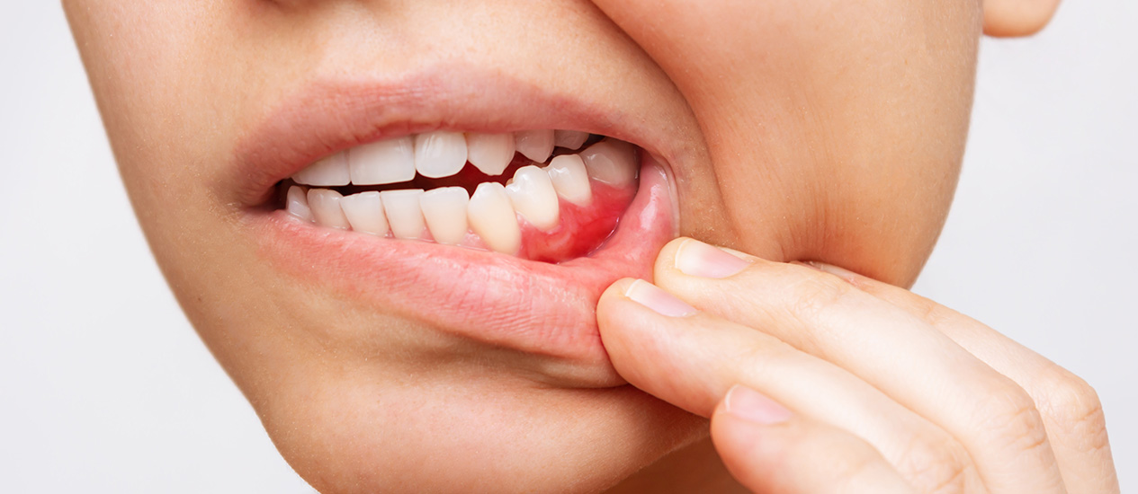 Parodontitis Stuttgart, Parodontose / Zahnfleischentzündung